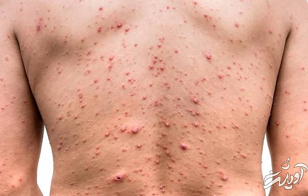 علل آبله مرغان